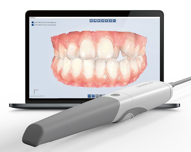 An intraoral 3D dental scanner wand resting in front of a laptop displaying a highly detailed digital scan of a patient's teeth and gums.