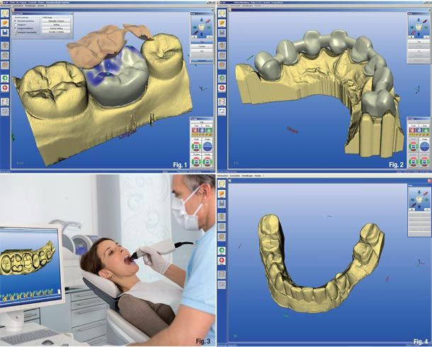 A four-panel infographic demonstrating the dental CAD/CAM process, including a dentist using an intraoral scanner on a patient.